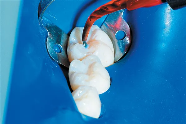 UltraSeal XT Plus A1 4 x 1,2 ml