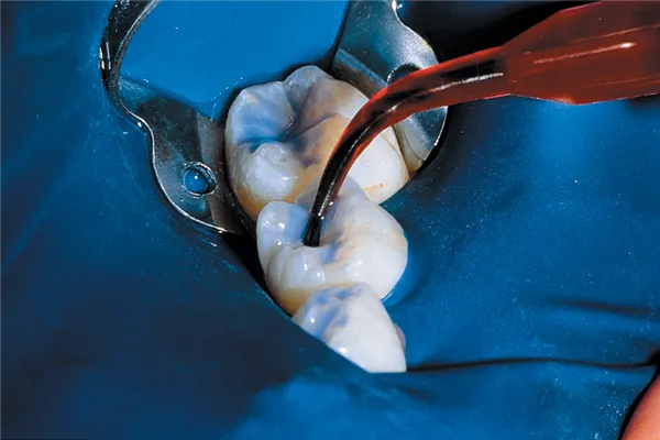 UltraSeal XT Plus A1 4 x 1,2 ml