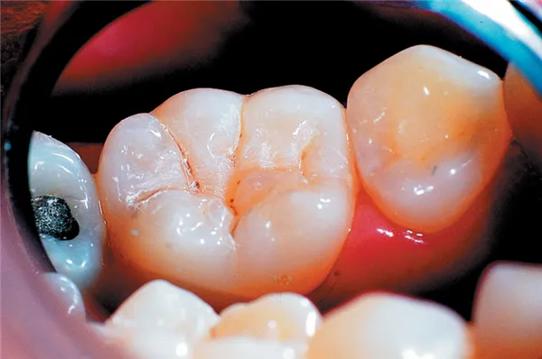 UltraSeal XT Plus A1 4 x 1,2 ml