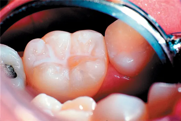 UltraSeal XT Plus A1 4 x 1,2 ml