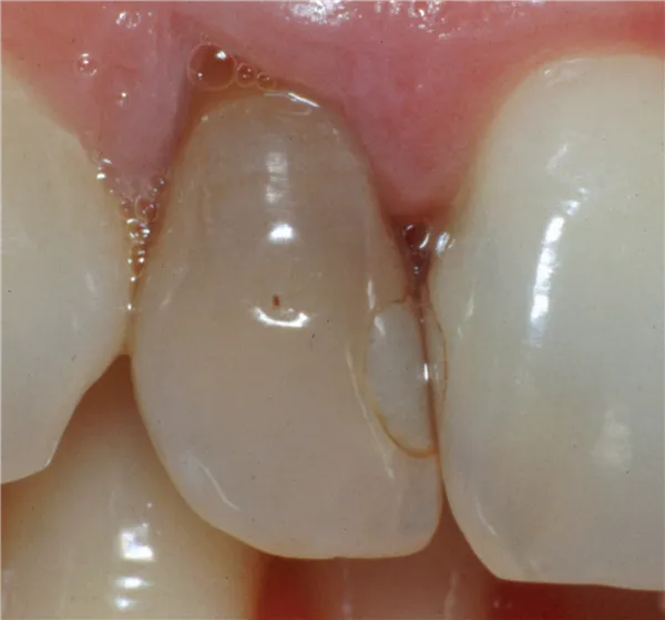 Opalescence Endo kit