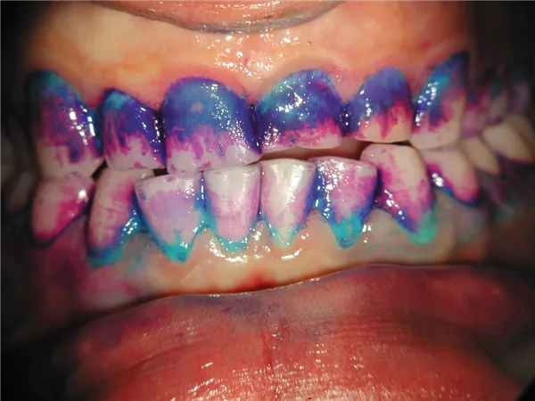 GC Tri Plaque ID gel