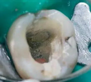 Biodentine 15 x 0,7 g