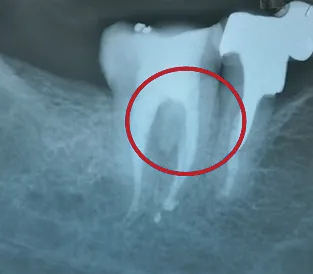 Biodentine 15 x 0,7 g