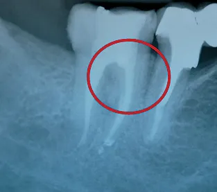 Biodentine 15 x 0,7 g