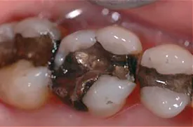 Biodentine 15 x 0,7 g
