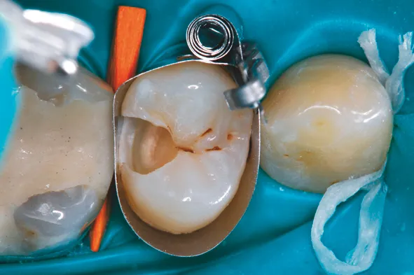 Biodentine 15 x 0,7 g