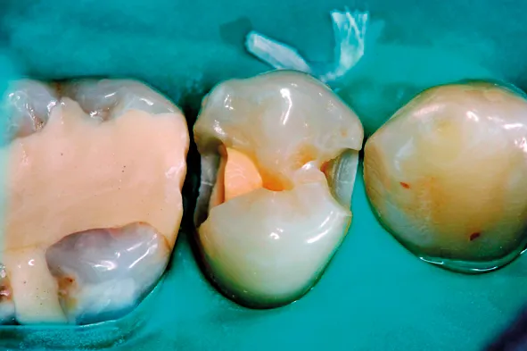 Biodentine 15 x 0,7 g