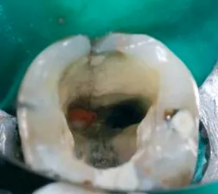 Biodentine 15 x 0,7 g
