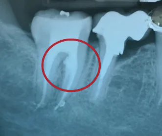 Biodentine 15 x 0,7 g