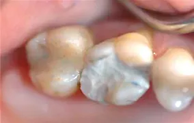 Biodentine 15 x 0,7 g