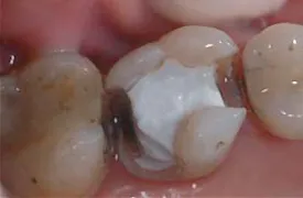 Biodentine 15 x 0,7 g