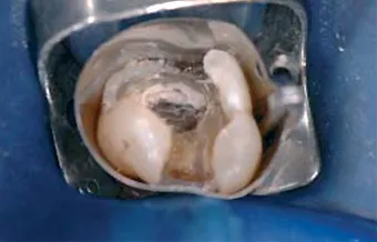 Biodentine 15 x 0,7 g