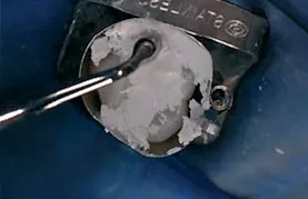 Biodentine 15 x 0,7 g