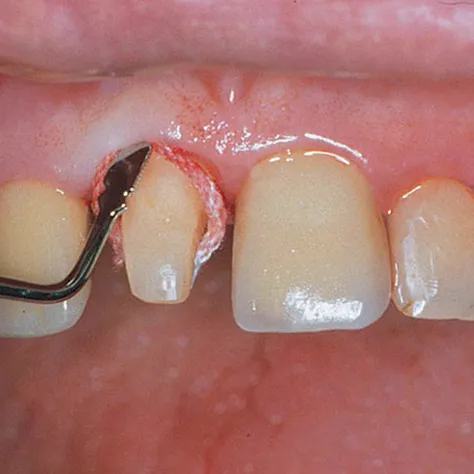 Comprecap Anatomic č.3 (M) 120 ks