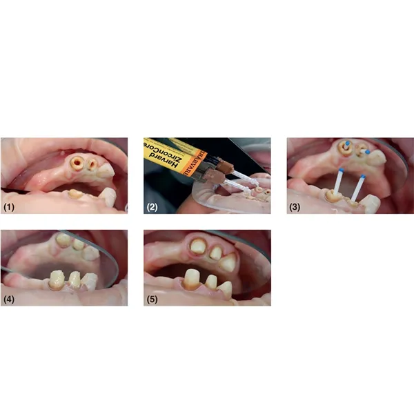 Harvard ZirconCore A3, 1 x 5 ml stříkačka, 10 mísících kanyl