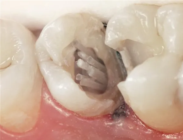 Dentapreg PINPOST 0,45x22mm ( 4x12ks)
