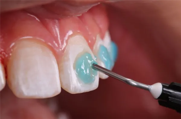 FGM ORTHOCEM Rastreador + Condac 37%
