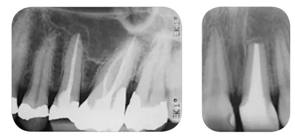 Hawe Super-Bite 4ks 1022