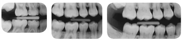 Kwik-Bite držák s kruhem 5ks