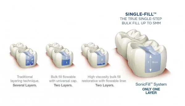 SonicFill 3 Refill A1 20x0,25g