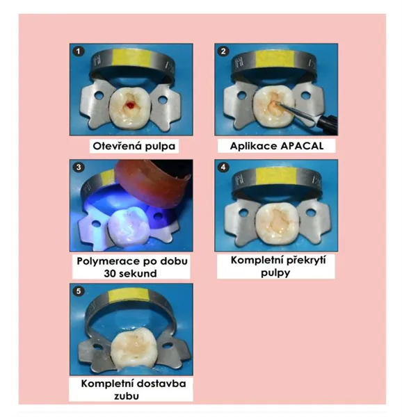 ApaCal ART 2x2g + 10 kanyl