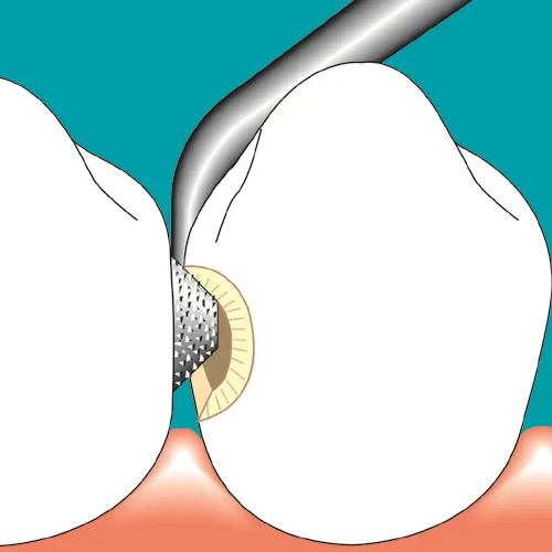 SONICflex bevel hrot č. 58